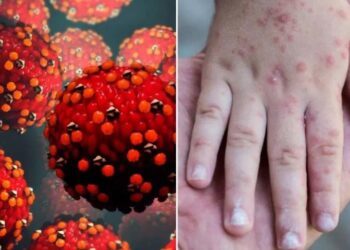 Identifica SSA 362 casos de sarampión
