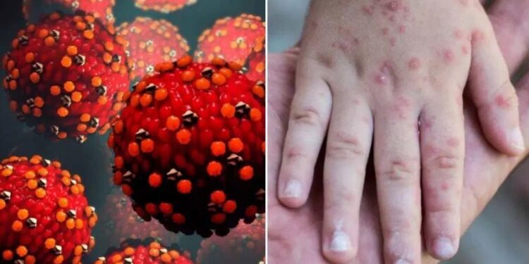 Identifica SSA 362 casos de sarampión