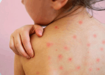 México rebasa los cinco mil casos de sarampión