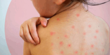 México rebasa los cinco mil casos de sarampión