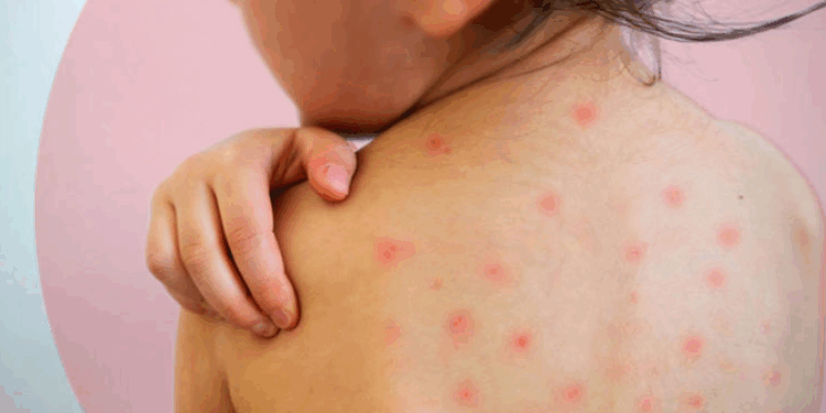 México rebasa los cinco mil casos de sarampión