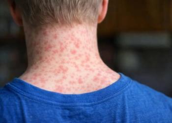 Van 35 muertes por sarampión