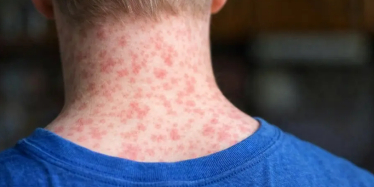 Van 35 muertes por sarampión