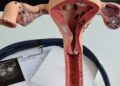 Asociación mexicana pide priorizar la atención del cáncer de ovario