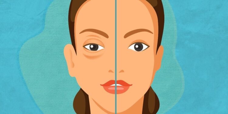 SESA alerta sobre síntomas del angioedema hereditario