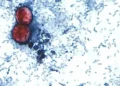 Alerta RU casos de ciclosporiasis ligados a viajes a México